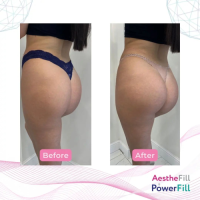 Power Fill 1000mg for Man Penis Enlargement More Natural and Effect Long Lasting Pdlla (poly-DL-lactide) Dermal Filler