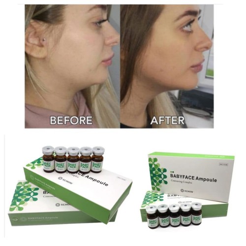Dissolving Babyface Belkyra Lipo Lab Red Ampoules Aqualyx Babyface Ampoule