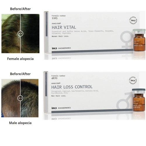 Hair Growth and Reduces Hair Loss Innoaesthetics Hair Loss Control for Man Reduces Scalp Oil Secretion and Normalizes T