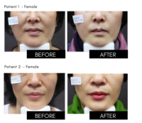 Plla Injectable Etrebelle Plla Hyaluronic Acid Collagen Stimulated Injection Product Pdrn Skin Care Injections Etrebell