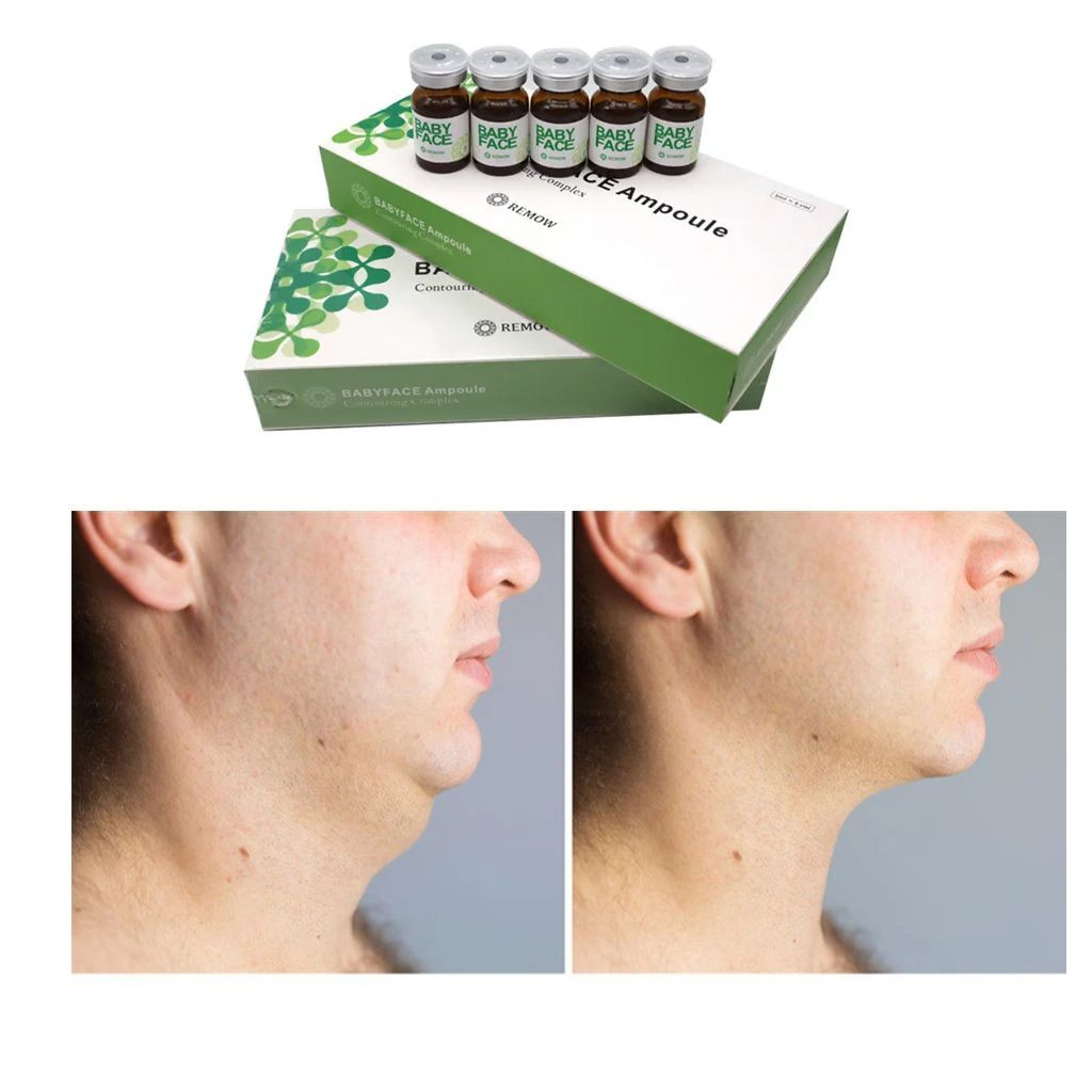 Dissolving Babyface Belkyra Lipo Lab Red Ampoules Aqualyx Babyface Ampoule
