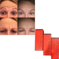 Best The Chaeum Premium No. 1234 Hyaluronic Acid Ha Dermal Filler