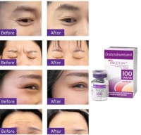Botox  100U Cosmetic Botulinum Toxin Type A (onabotulinumtoxinA) 100 Units Injection Single-Dose Vial