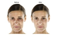 Filorga Nctf 135ha/Fillmed Nctf 135 Ha Dermal Filler Fillmed Nctf 135haha Filler Facial Skin Care Fillmed Nctf 135ha En
