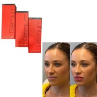 Best The Chaeum Premium No. 1234 Hyaluronic Acid Ha Dermal Filler