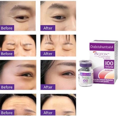 Botox Cosmetic Botulinum Toxin Type A (onabotulinumtoxinA) 100 Units Injection Single-Dose Vial